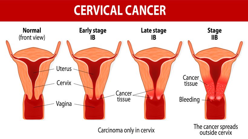 Nepal: Cervical cancer cases on the rise due to lack of awareness about this health issue among women